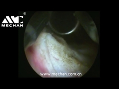 Système de chirurgie plasmatique en urologie pour le traitement de l'HBP