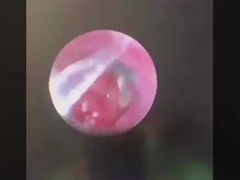 Butterfly ENT Instruments de chirurgie ENT sonde