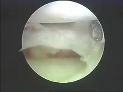 Produits d'ablation de systèmes d'ablation d'instruments d'Electrosurgical pour l'épine et les joints