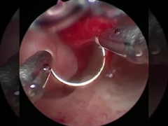 Technologie de refroidissement électrode de chirurgie au plasma pour les procédures d'urologie de l'HBP