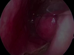 Probe neurologique ultra-petite et flexible jetable PLA407